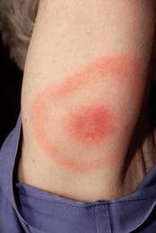 Bull's-eye rash